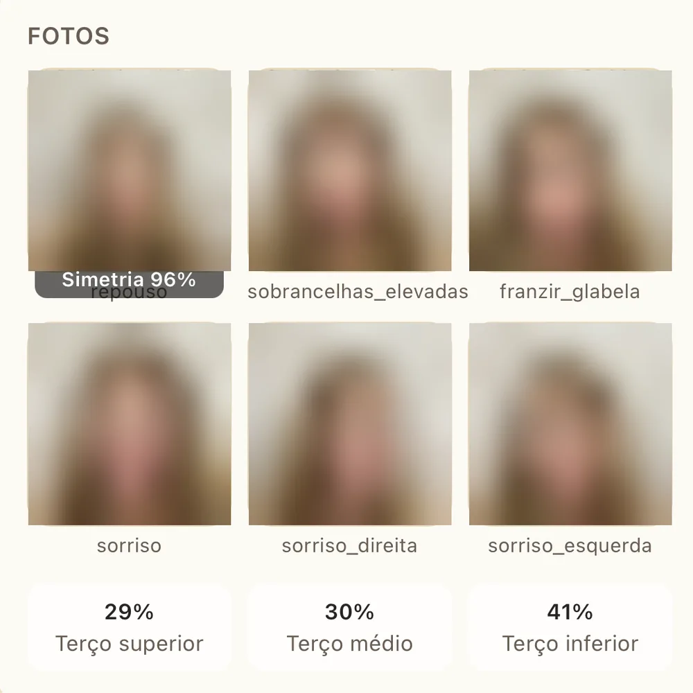 Tela com as seis fotos enviadas pela paciente, cada uma nomeada — repouso, sobrancelhas elevadas, franzir glabela, sorriso, sorriso à direita e sorriso à esquerda — com a medição de simetria em 96% e a distribuição entre terço superior, médio e inferior. Os rostos aparecem borrados.